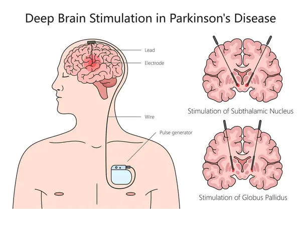 Deep Brain Stimulation Structure Parkinson Disease Diagram Hand Drawn Schematic — Stock Photo, Image