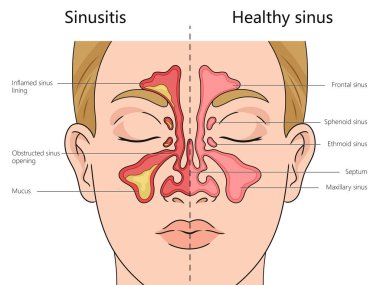 Sinusitis structure diagram hand drawn schematic vector illustration. Medical science educational illustration clipart