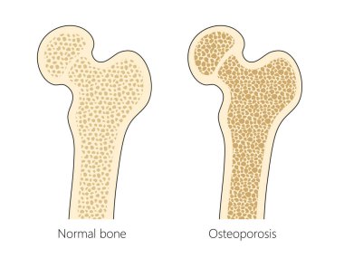 Osteoporoz diyagramı olan insan kemik yapısı el çizimi şematik vektör çizimi. Tıp bilimi eğitimsel illüstrasyon