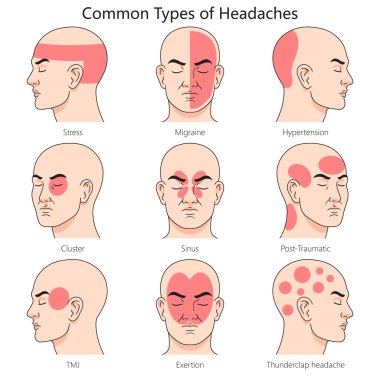İnsan baş ağrısı tipi yapı diyagramı el çizimi şematik vektör çizimi. Tıp bilimi eğitimsel illüstrasyon