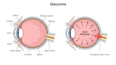 anatomy of a human eye with glaucoma, highlighting increased pressure and optic nerve damage structure diagram hand drawn schematic raster illustration. Medical science educational illustration clipart
