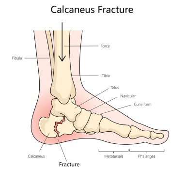 Calcaneus fracture structure diagram hand drawn schematic raster illustration. Medical science educational illustration clipart