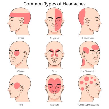 İnsan baş ağrısı tipi yapı diyagramı. El çizimi şematik raster çizimi. Tıp bilimi eğitimsel illüstrasyon