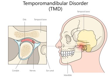 İnsan Temporomandibular Bozukluğu diyagramı. El çizimi şematik raster çizimi. Tıp bilimi eğitimsel illüstrasyon