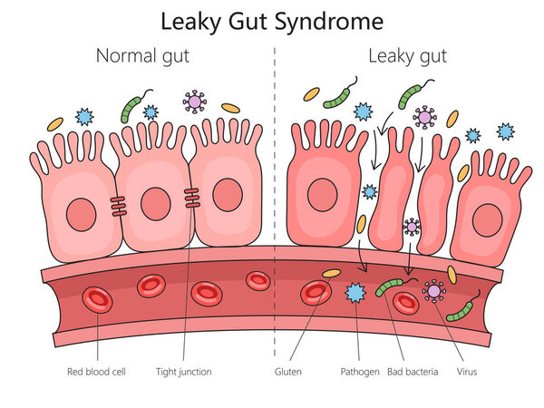 normal gut and leaky gut syndrome with labeled elements like bacteria and tight junctions structure diagram hand drawn schematic raster illustration. Medical science educational illustration