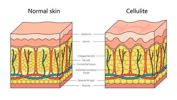 Diagrama Estructura Piel Celulitis Humana Ilustración Trama Esquemática Dibujada Mano —  Fotos de Stock