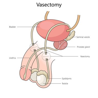 Erkek üreme sisteminde vazektomi, anahtar anatomik özellikleri vurguluyor yapı diyagramı el çizimi şematik vektör çizimi. Tıp bilimi eğitimsel illüstrasyon