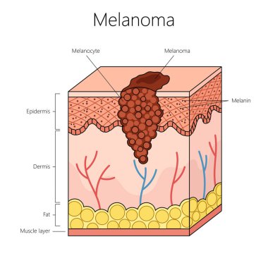 Melanosit ve deri katmanlarına odaklı melanom cilt kanseri üst deri ve deri yapısı diyagramı el çizimi şematik vektör çizimi de dahil. Tıp bilimi eğitimsel illüstrasyon