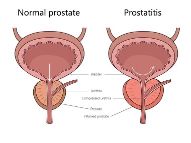 Normal prostat ve protez iltihabı, iltihaplanma ve sıkıştırma yapısı diyagramını gösteriyor. El çizimi şematik raster çizimi. Tıp bilimi eğitimsel illüstrasyon