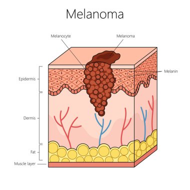 melanoma skin cancer with a focus on melanocyte and skin layers including the epidermis and dermis structure diagram hand drawn schematic raster illustration. Medical science educational illustration clipart