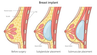 Ameliyattan önce göğüs anatomisinin karşılaştırılması ve subglandüler ve subkasküler göğüs implantı yerleştirme yapı diyagramı el yapımı raster çizimi. Tıp bilimi eğitimsel illüstrasyon
