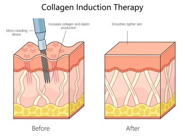 skin structure before and after collagen induction therapy using a micro-needling device for enhanced skin texture diagram schematic vector illustration. Medical science educational illustration clipart