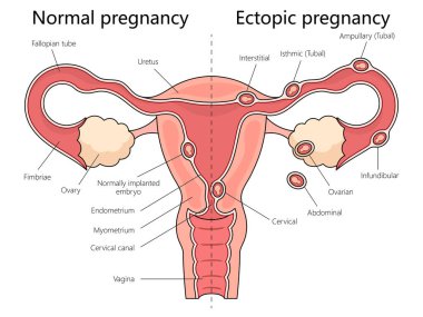 Human normal and ectopic pregnancies with labeled female reproductive system structure diagram hand drawn schematic vector illustration. Medical science educational illustration clipart