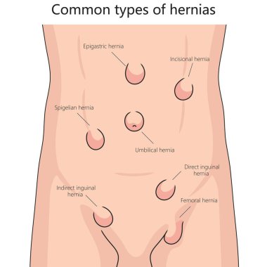 Human various hernia types on human abdomen for health and medical studies structure diagram hand drawn schematic vector illustration. Medical science educational illustration clipart
