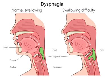 disfaji yutma zorluğu ve etiketli anatomi yapısı omur diyagramı ile normal yutma el çizimi şematik vektör çizimi. Tıp bilimi eğitimsel illüstrasyon
