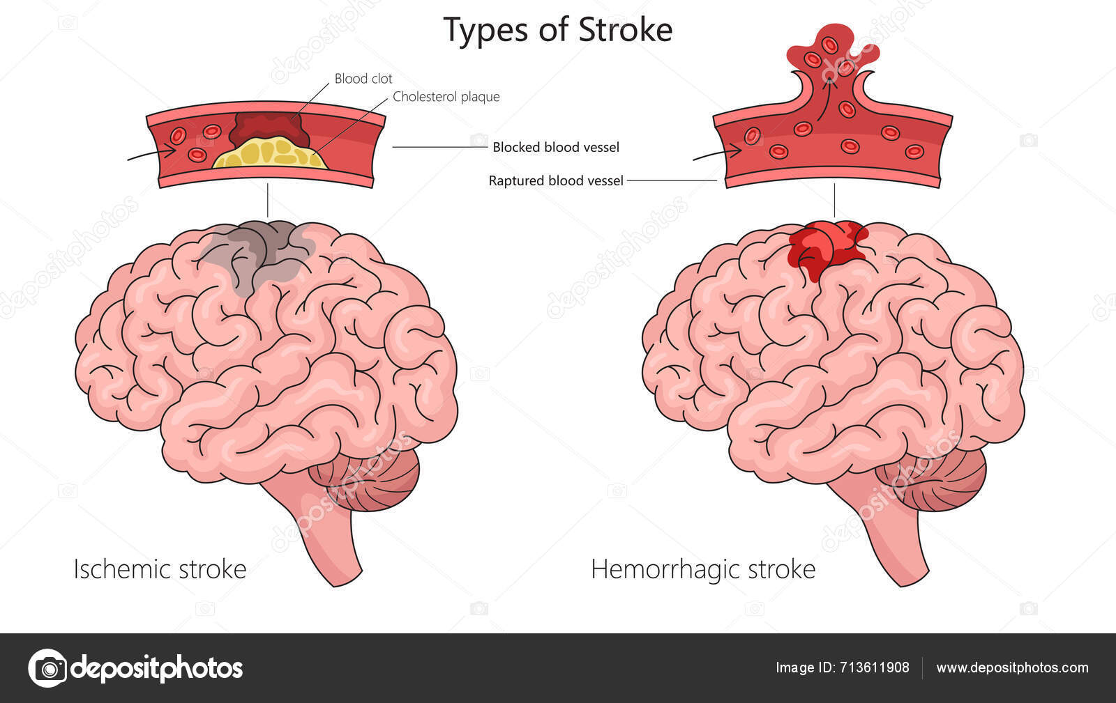 Stroke Iskemik Manusia Dan Stroke Hemoragik Pada Anatomi Otak Manusia