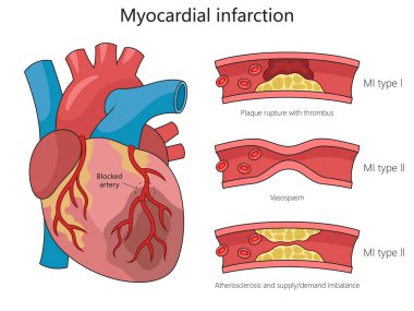 İnsan kalbi anatomisi ve eğitim amaçlı miyokard enfarktüsünün farklı türleri el yapısı diyagramı şematik raster çizimi. Tıp bilimi eğitimsel illüstrasyon