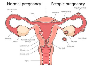 Human normal and ectopic pregnancies with labeled female reproductive system structure diagram hand drawn schematic raster illustration. Medical science educational illustration clipart