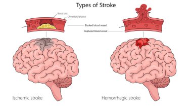 İnsan iskemik felci ve beyin anatomisi diyagramında kanamalı felç şematik raster çizimi. Tıp bilimi eğitimsel illüstrasyon