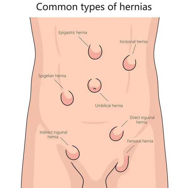 Humanos Varios Tipos Hernia Abdomen Humano Para Salud Los Estudios —  Fotos de Stock