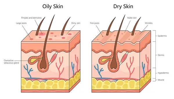Menschliche Fettige Haut Mit Trockener Haut Unterschiede Talgdrüsenaktivität Porengröße Und — Stockvektor