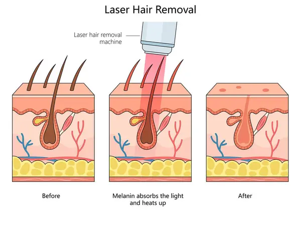 Laser Haarentfernung Die Die Haut Vor Während Und Nach Dem — Stockvektor