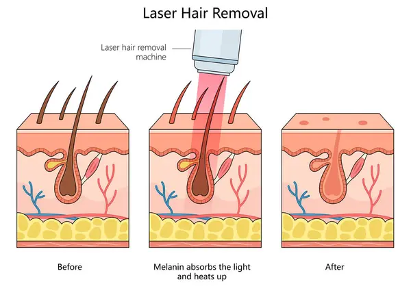 Laser Haarentfernung Die Die Haut Vor Während Und Nach Dem — Stockfoto
