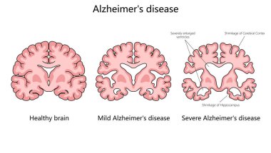 Alzheimer hastalığının ilerlemesi, sağlıklı bir beyni hafif ve şiddetli Alzheimer yapı diyagramı olan elle çizilmiş şematik vektör çizimleriyle karşılaştırır. Tıp bilimi eğitimsel illüstrasyon