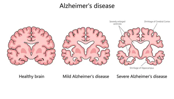 Progresión Enfermedad Alzheimer Comparando Cerebro Sano Ésos Con Ilustración Esquemática — Archivo Imágenes Vectoriales