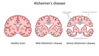 Alzheimer hastalığının ilerlemesi, sağlıklı bir beyni hafif ve şiddetli Alzheimer yapı diyagramı olan elle çizilmiş şematik raster çizimleriyle karşılaştırmak. Tıp bilimi eğitimsel illüstrasyon