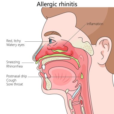 Allergic rhinitis, showing symptoms like sneezing, watery eyes, and inflammation diagram hand drawn schematic vector illustration. Medical science educational illustration clipart