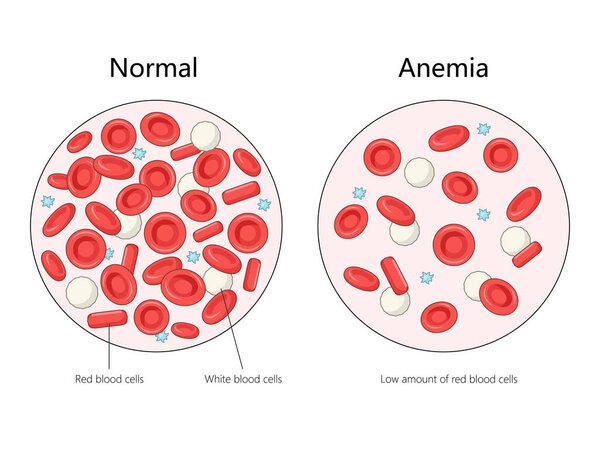 normal blood cells with anemic blood cells, highlighting the low amount of red blood cells in anemia diagram hand drawn schematic vector illustration. Medical science educational illustration