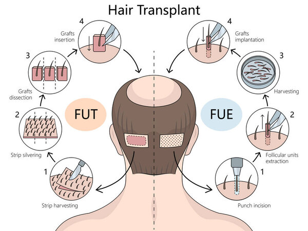 Follicular Unit Transplantation FUT and Follicular Unit Extraction FUE hair transplant techniques diagram hand drawn schematic vector illustration. Medical science educational illustration