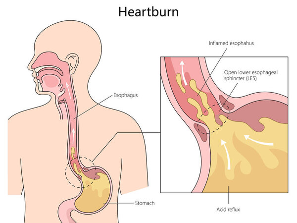 anatomy of heartburn and acid reflux, with labeled parts of the esophagus and stomach diagram hand drawn schematic raster illustration. Medical science educational illustration