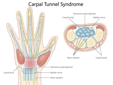 Karpal tünel sendromunun anatomisi, orta sinir, esnek tendonlar ve karpal kemikler el çizimi şematik vektör çizimi. Tıp bilimi eğitimsel illüstrasyon