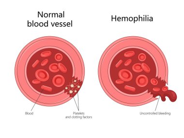 Normal bir kan damarını hemofili ile karşılaştırmak pıhtılaşma ve kanamalı diyagram farklılıkları el çizimi şematik vektör çizimi. Tıp bilimi eğitimsel illüstrasyon