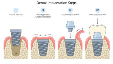 Diş implantasyonu, implant yerleştirme, iyileşme süreci, ayak bileği yerleştirme, protez yerleştirme diyagramı el yapımı şematik raster çizimi. Tıp bilimi eğitimsel illüstrasyon