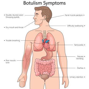 Botulizm belirtileri, görme sorunları, kas felci, yutma zorluğu, solunum problemleri, elle çizilmiş şematik raster çizimi. Tıp bilimi eğitimsel illüstrasyon