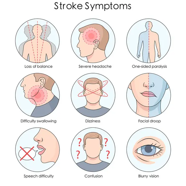 stock image common stroke symptoms, dizziness, severe headache, facial droop, speech difficulty, and one-sided paralysis diagram hand drawn schematic raster illustration. Medical science educational illustration