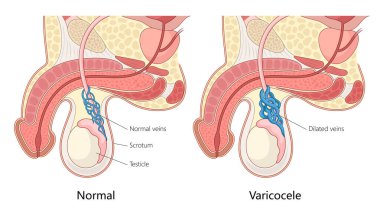 normal veins and varicocele, dilated veins in the scrotum affecting the testicle hand drawn schematic vector illustration. Medical science educational illustration