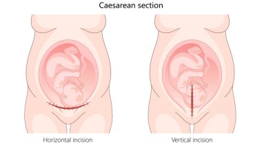 Sezaryen bölümü yatay ve dikey kesiklerle cerrahi yöntemlerle bebek doğurtmak için elle çizilmiş şematik vektör illüstrasyonu. Tıp bilimi eğitimsel illüstrasyon