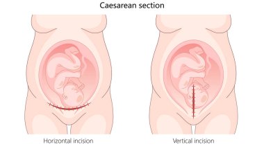Sezaryen bölümü yatay ve dikey kesiklerle cerrahi yöntemlerle bebek doğurtmak için elle çizilmiş şematik raster çizimi. Tıp bilimi eğitimsel illüstrasyon