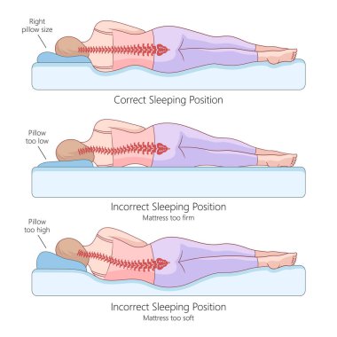 proper and improper side sleeping positions with spine alignment, the effects of pillow height and mattress firmness diagram hand drawn vector illustration. Medical science educational illustration clipart