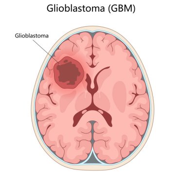 Glioblastoma tümörü etiketli beynin enine kesiti konumunu ve el çizimi şematik raster çizimlerini vurguluyor. Tıp bilimi eğitimsel illüstrasyon