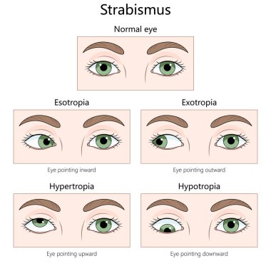 Farklı tip Strabismus, esotropia, exotropia, hypertropia, hipotropia, karşılaştırma amaçlı normal göz örnekleri. Tıp bilimi eğitimsel illüstrasyon
