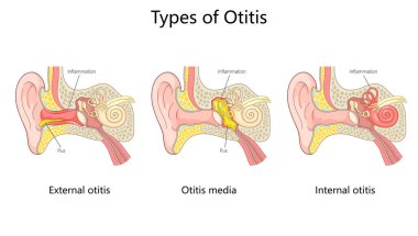 otitis kulak enfeksiyonları dış otitis, otitis medyası ve iltihaplı iç otitis ve iltihaplanma ve iltihaplanma diyagramı el çizimi şematik vektör çizimi. Tıp bilimi eğitimsel illüstrasyon