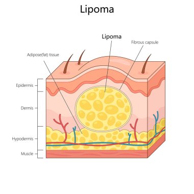 Lipoma, üst derisi, derisi, derialtı derisi ve fibröz kapsül yapı diyagramı dahil olmak üzere etiketli deri katmanlarıyla el çizimi şematik vektör çizimi. Tıp bilimi eğitimsel illüstrasyon