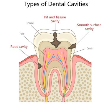 Bir çeşit diş çürüğü. Kök boşluğu, çukur ve çatlak boşluğu, ve düz yüzey boşluğu diyagramı el çizimi şematik vektör çizimi. Tıp bilimi eğitimsel illüstrasyon