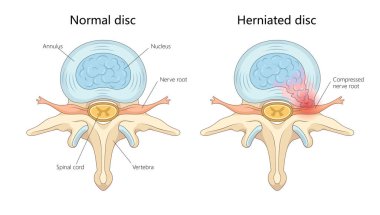 Normal omurilik diski ve sıkıştırılmış sinir köküne sahip fıtık diski, berraklık diyagramı el çizimi şematik raster çizimi için etiketlenmiş. Tıp bilimi eğitimsel illüstrasyon