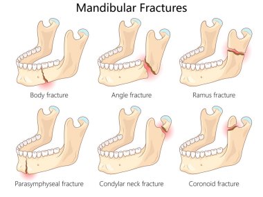 Alt çene kırıkları, vücut, açı, ramus, parasymphyseal, kondylar boyun ve el çizimi şematik raster çizimi koronoid kırıkları da dahil. Tıp bilimi eğitimsel illüstrasyon
